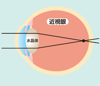 近視とは