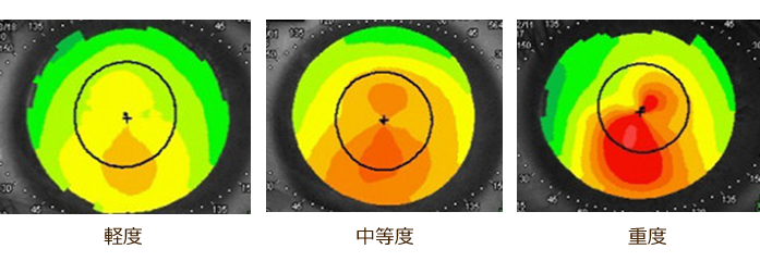 軽度 中等度 重度